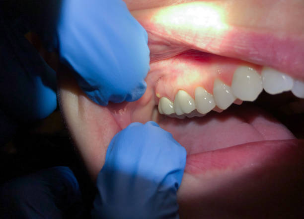 Best Emergency Gum Treatment in Tyro, NC